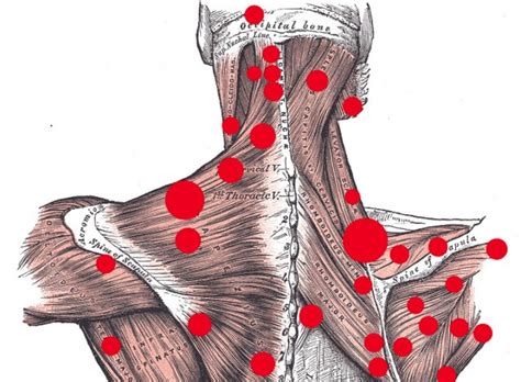 trigger point wiki